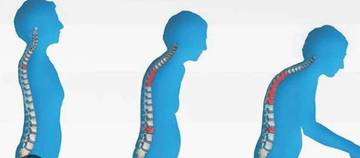 Tips Menjaga Kesehatan Tulang Cegah Osteoporosis