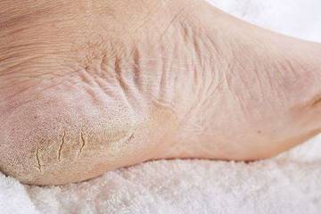 Cara Efektif Mengatasi Kaki Pecah-Pecah
