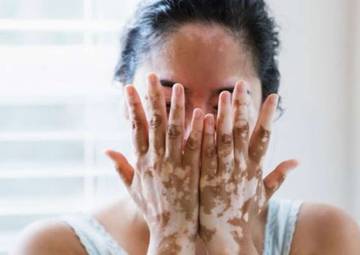 Apa Sih Vitiligo Itu, Gejala dan Penyebabnya??