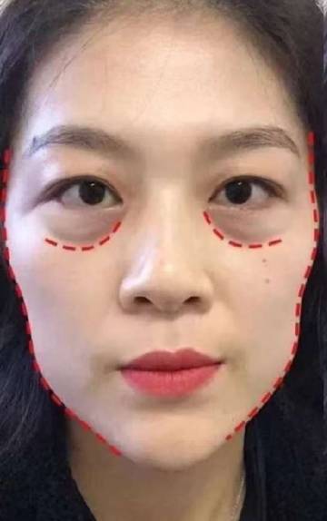 Tips Mengatasi Kantung Mata 