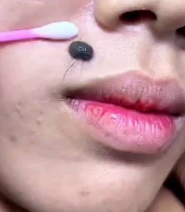 Kenapa Disebut Tahi Lalat?