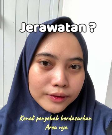 Kenali Jerawat dari Area Tumbuhnya