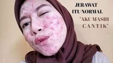 Penyebab Jerawat di Usia 35 Tahun ke Atas?