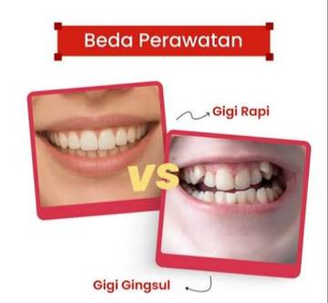 Plus Minus Gigi Gingsul: Antara Pesona dan Perawatan
