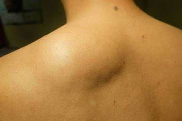 Tips Alami Menghilangkan Lipoma
