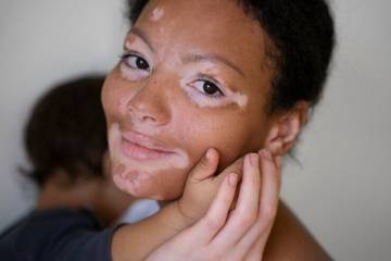 Vitiligo, Penyakit Kulit yang dapat Sebabkan Stres dan Depresi