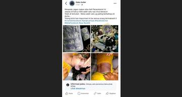 [HOAX] Foto Korban Virus Machupo Akibat Paracetamol P-500