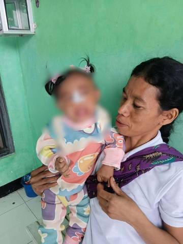 Perjuangan Yosefasania, Balita Manggarai Butuh Bantuan Pengobatan Jantung