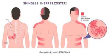 Waspada Herpes Zoster Menyerang Lansia