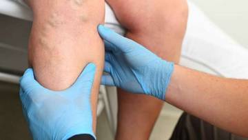 Solusi Penanganan Varises untuk Kesehatan Kaki