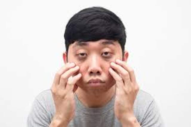 Sering Disebut Mata Ngantuk, Apa Itu Ptosis? 