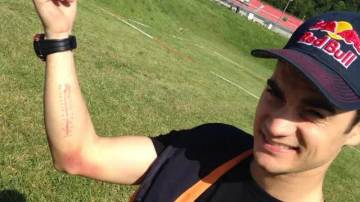 Fasciotomy, Operasi untuk Hindari Risiko Cedera Pembalap MotoGP 