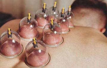Pengobatan Tradisional Bekam Masih Diminati di Zaman Sekarang