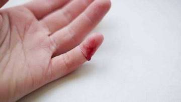 Menghisap Jari Saat Terluka, Benarkah Bikin Cepat Sembuh?