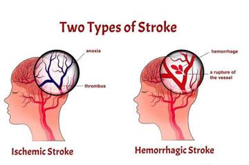 Peringati Hari Stroke Sedunia, Pentingnya Deteksi Dini 