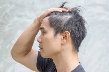  Rambut Memutih di Usia Muda? Ini Penjelasan Medisnya