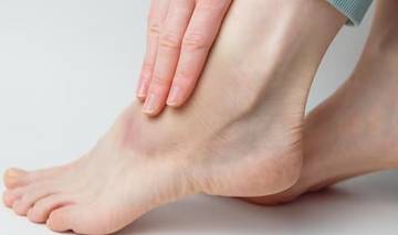 Waspada Kaki Bengkak Bisa Jadi Tanda Penyakit Serius