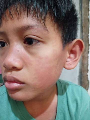 Biduran Pada Anak, Waspadai Gejalanya