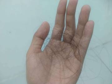 Rambut Rontok, Apakah Normal? Ini Penjelasannya