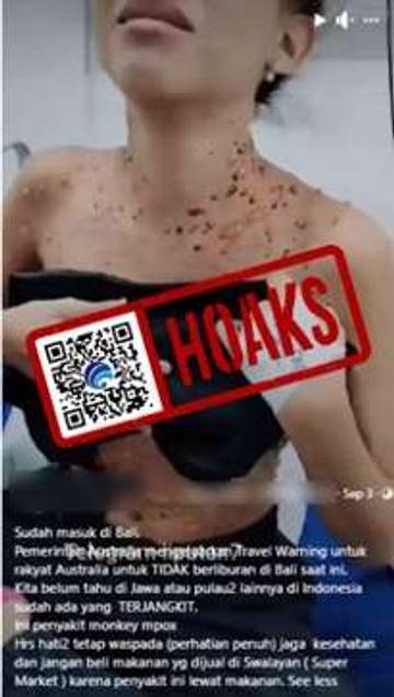 Hoaks Video Penemuan Kasus Mpox di Provinsi Bali