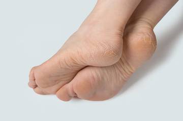 Mengatasi Kaki Pecah-Pecah