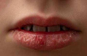 Cara Mengatasi Bibir Pecah-pecah