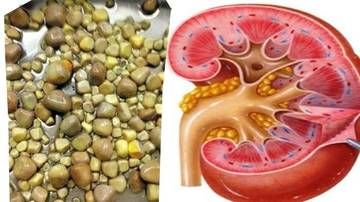 Hindari Batu Ginjal,Kenali Makan dan Minuman Pemicu