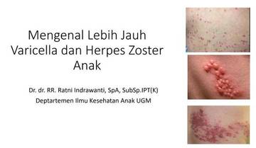 Imunisasi Varicella Efektif Cegah Herpes Zoster