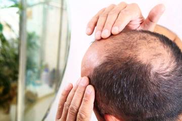 Penyebab Rambut Rontok Pada Pria