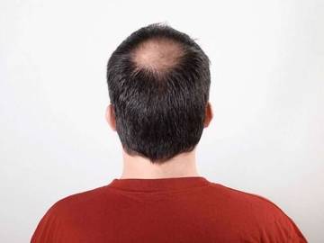 Cara Mencegah Munculnya Masalah Rambut