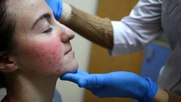 Fakta Hari Lupus Sedunia, Mitos Penyakit Kutukan