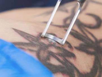 Bahaya Tersembunyi di Balik Hapus Tato 