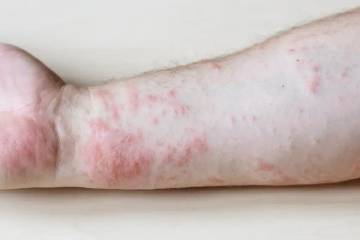 Mengenal Penyakit Lupus (Systemic Lupus Erythematosus)