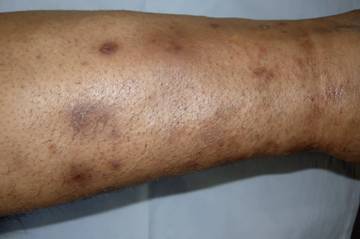 Tanda-Tanda Kandungan Gula Berlebihan dalam Tubuh