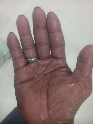 Benarkah Tangan Berkeringat Identik Dengan Sakit Jantung
