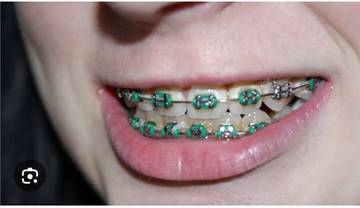 Tips Memilih Jenis Kawat Gigi