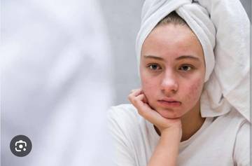 Jerawat Saat Menstruasi?  Ini Penjelasan Medis