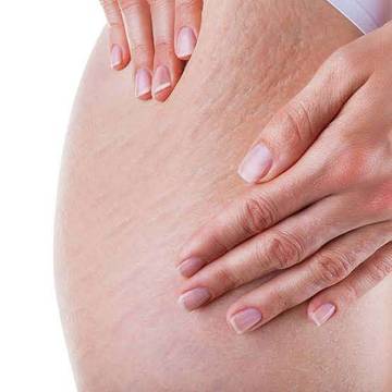 Menyamarkan Stretch Mark Dengan Bahan Tradisional
