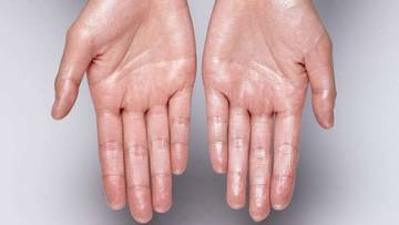 Apa itu Hiperhidrosis?