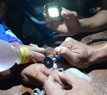 Detik-detik Pelepasan Cincin dari Jari Tangan Anak di Pamekasan